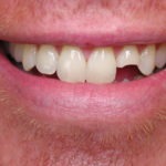 dental bonding, broken tooth, cosmetic dentistry