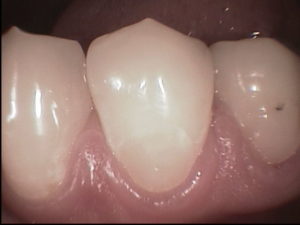 sensitive notches tooth ugly cosmetic