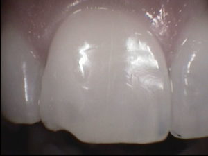 Dallas dentist Plano Richardson Addison bonding chip repair composite
