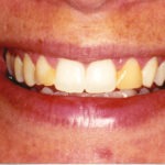 Dallas dentist Plano Richardson Addison porcelain veneers laminates cosmetic