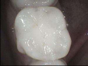 a CEREC crown by Dr. Venincasa