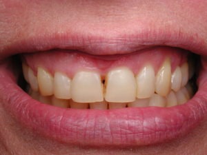 Dallas dentist Plano Richardson Addison smile makeover bonding