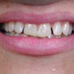 Zoom 1 teeth whitening Zoom bleaching