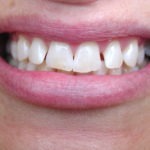 Zoom 2 teeth whitening Zoom bleaching
