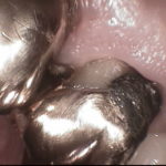 dental implant tooth missing 
