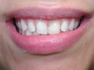 dental bonding, front teeth gaps, Venincasa Dental