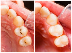 white filling, Venincasa Dental