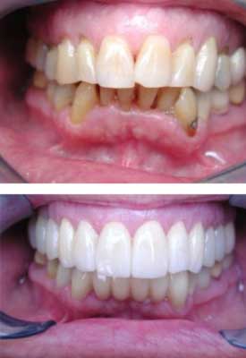 crowns for smiling by Dr. Venincasa