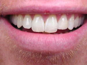 dental bonding, smile makeover
