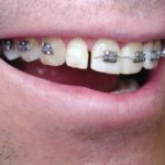 braces, orthodontics, cosmetic dentistry, bonding, veneers