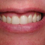 Dallas dentist Plano Richardson Addison cosmetic makeover bonding whitening