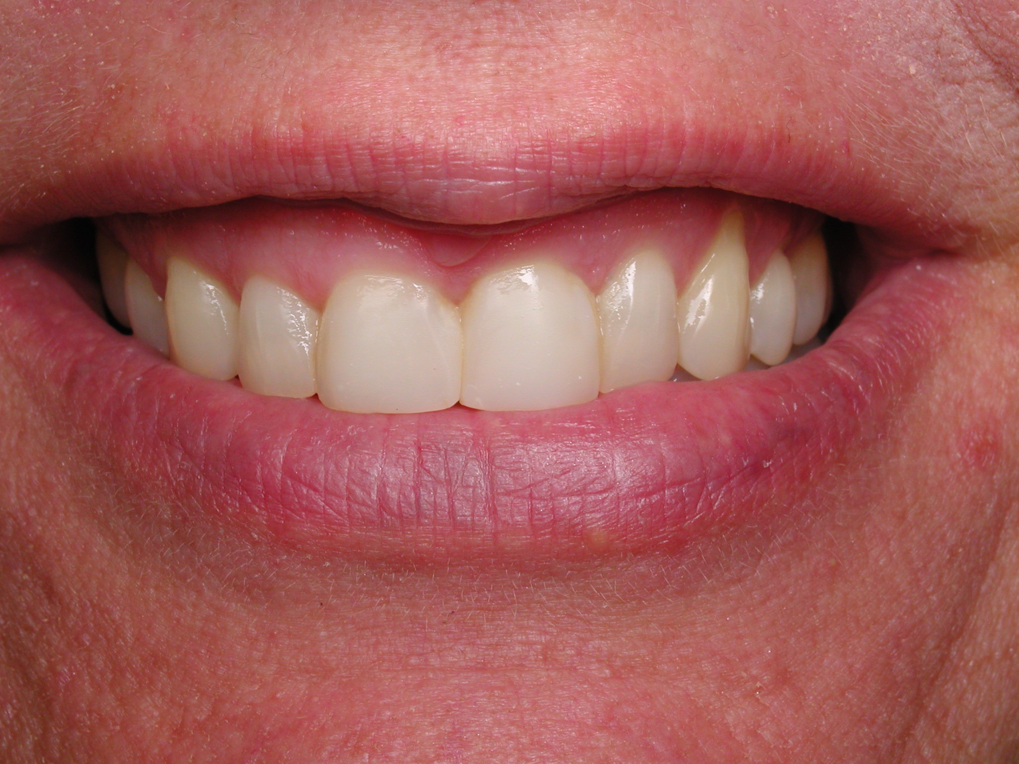 filling between teeth