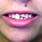dental bonding, repairing broken teeth