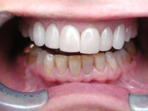 replacing porcelain veneers laminates quality cosmetic dentistry