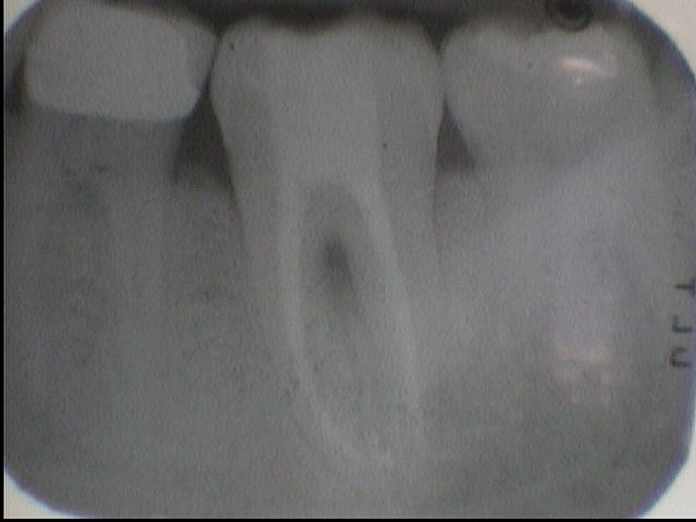 root canal, Venincasa Dental, toothache, tooth pain, Dallas dentist