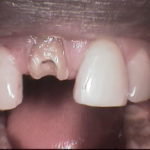 broken front tooth, emergency, bonding, cosmetic dentistry