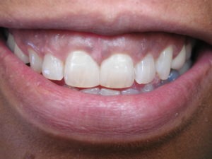 bonding gaps cosmetic dentistry smile makeover