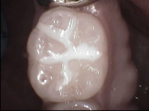 A newly placed dental sealant prevents decay