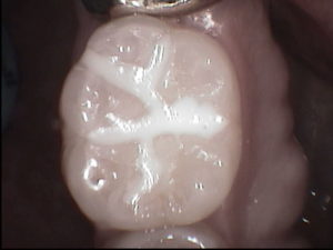 Sealants help to prevent decay Dallas dentist Plano Richardson Addison sealant preventive conservative