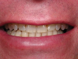 Dallas dentist Plano Richardson Addison Zoom whitening bleaching