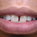 bonding front teeth gap cosmetic dentist