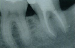 root canal dentist treatment pain-free, Venincasa Dental