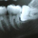 Dallas dentist Plano Richardson Addison oral surgery wisdom impaction