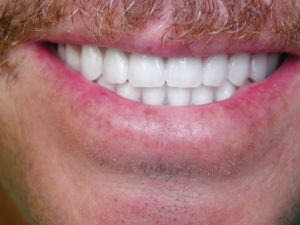 cosmetic dental makeover, dentures