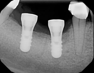 dental implants, missing teeth