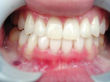 Bonding, crowns, veneers, makeover