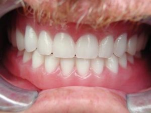 smile makeover, cosmetic makeover, dentures, north Dallas dentist, Plano dentist, Richardson dentist