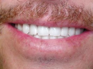 smile makeover, cosmetic makeover, dentures, north Dallas dentist, Plano dentist, Richardson dentist