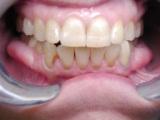 porcelain veneers,