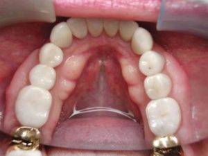 porcelain crowns