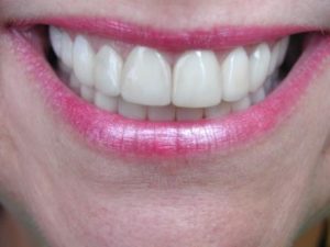 Cosmetic Smile Makeover
