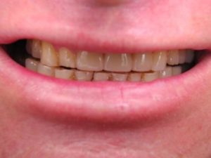 missing tooth, smile makeover, makeover, cosmetic, bridge