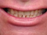 missing tooth, makeover, smile makeover, cosmetic, missing tooth