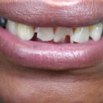 bonding, whitening, smile makeover, cosmetic dentistry