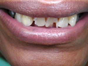 bonding, whitening, smile makeover, cosmetic dentistry