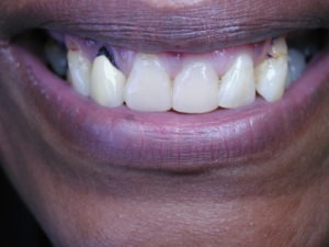 bonding, teeth whitening, cosmetic dentistry, smile makeover