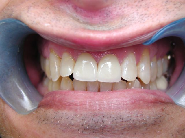 cosmetic dentistry, chipped and broken teeth