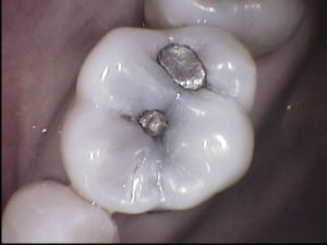 Decayed filling, weaker tooth