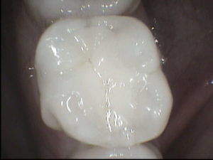 dental crown, partial dental crown