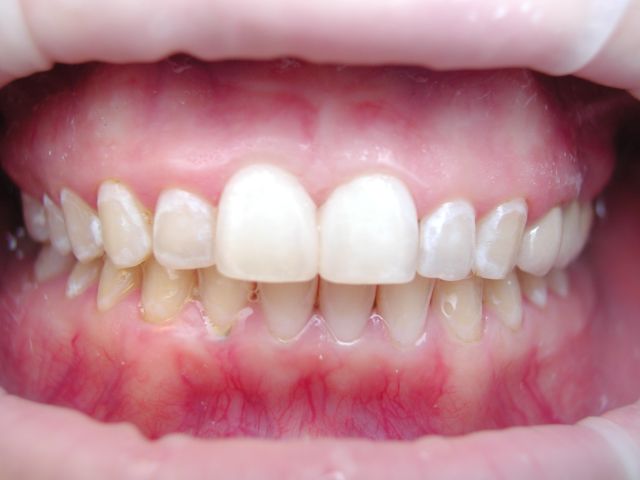 dental bonding, Venincasa Dental, smile makeover