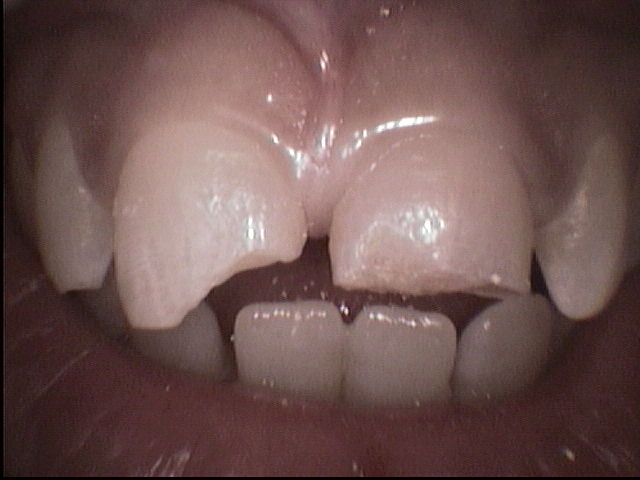 broken teeth, Venincasa Dental, Dallas dentist