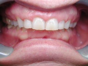 Gummy smile, shaping gums, cosmetic dentistry, Venincasa Dental