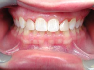 dental bonding, Venincasa Dental