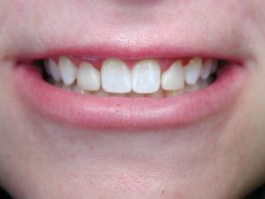 dental bonding, peg teeth, Venincasa Dental