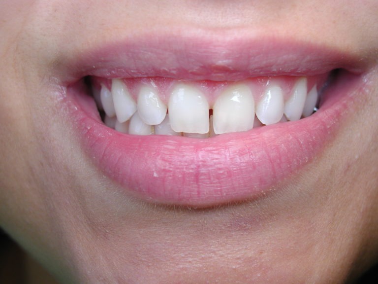 dental bonding, gaps in front teeth, Venincasa Dental