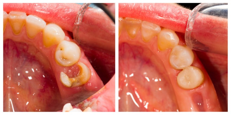 Gap in Teeth, Venincasa Dental, Dallas dentist